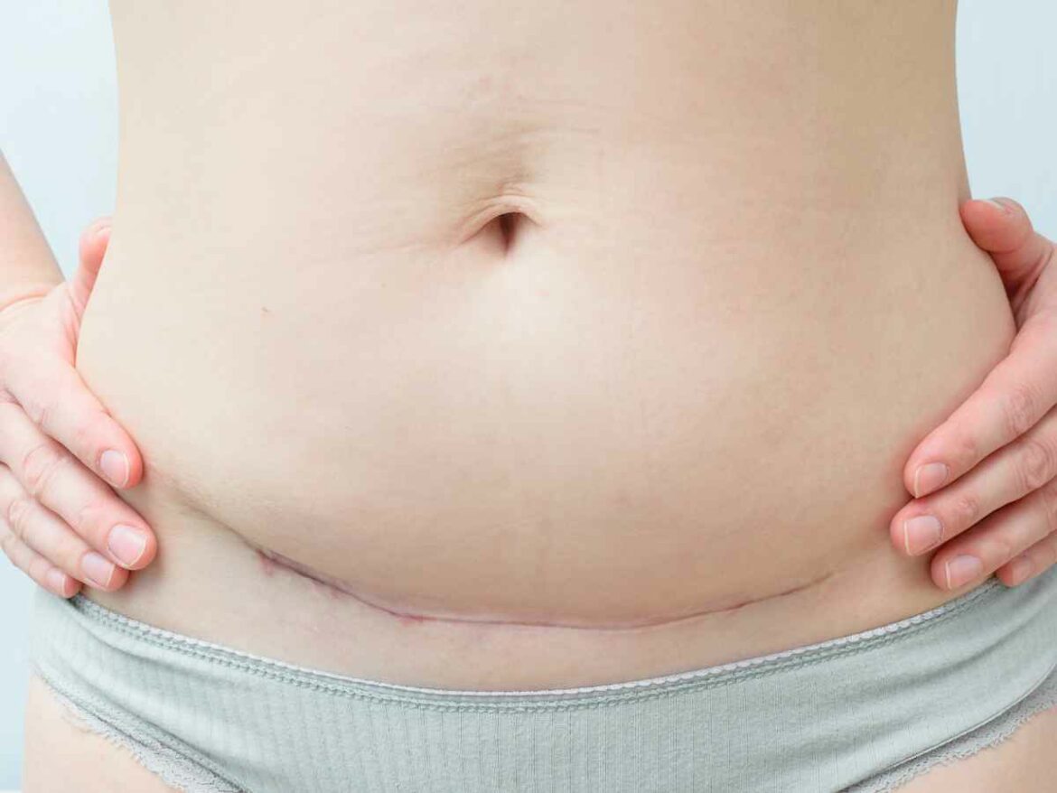 Close do abdômen de uma mulher no puerpério, evidenciando a cicatriz de uma cesárea e as mudanças corporais comuns no pós-parto, como a flacidez abdominal. A imagem representa o processo de recuperação após o nascimento do bebê.