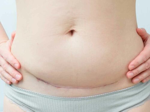 Close do abdômen de uma mulher no puerpério, evidenciando a cicatriz de uma cesárea e as mudanças corporais comuns no pós-parto, como a flacidez abdominal. A imagem representa o processo de recuperação após o nascimento do bebê.