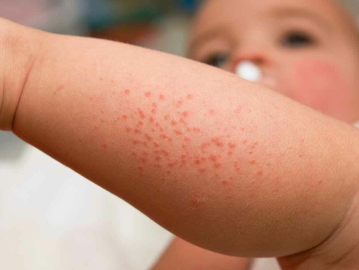 Close na perna de um bebê com brotoejas, mostrando pequenas bolinhas vermelhas características da irritação.