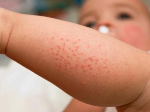 Close na perna de um bebê com brotoejas, mostrando pequenas bolinhas vermelhas características da irritação.