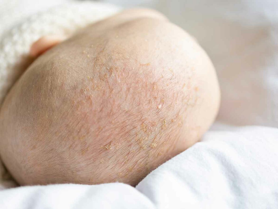 Close no couro cabeludo de um bebê com leve descamação, evidenciando sinais comuns de ressecamento.