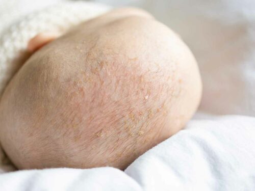 Close no couro cabeludo de um bebê com leve descamação, evidenciando sinais comuns de ressecamento.