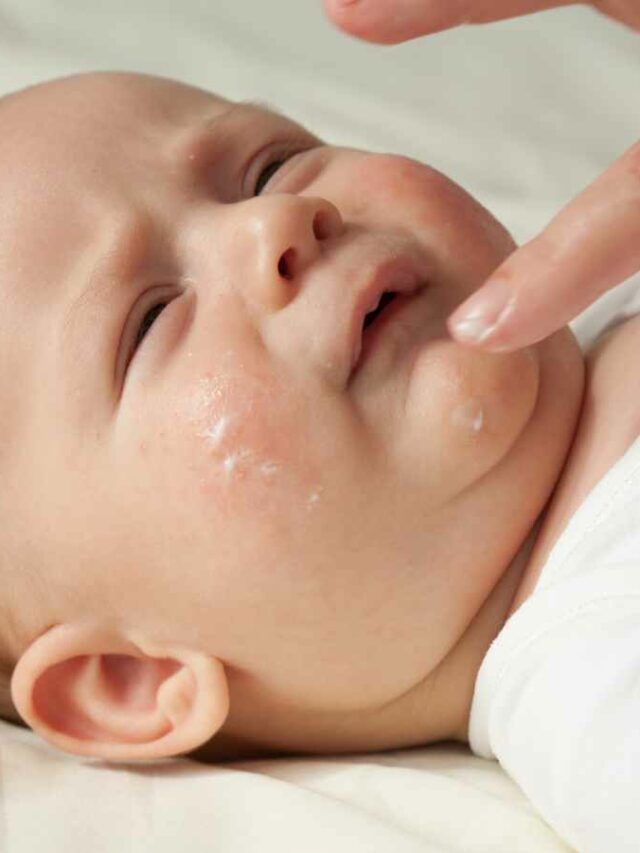 Mão de adulto aplica creme no rosto de um bebê com leve irritação na pele, destacando cuidados com a hidratação e proteção da pele sensível do recém-nascido.