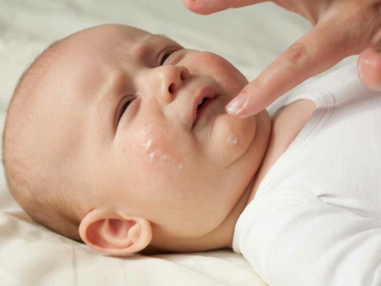 Mão de adulto aplica creme no rosto de um bebê com leve irritação na pele, destacando cuidados com a hidratação e proteção da pele sensível do recém-nascido.