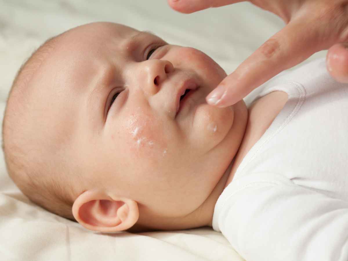 Mão de adulto aplica creme no rosto de um bebê com leve irritação na pele, destacando cuidados com a hidratação e proteção da pele sensível do recém-nascido.