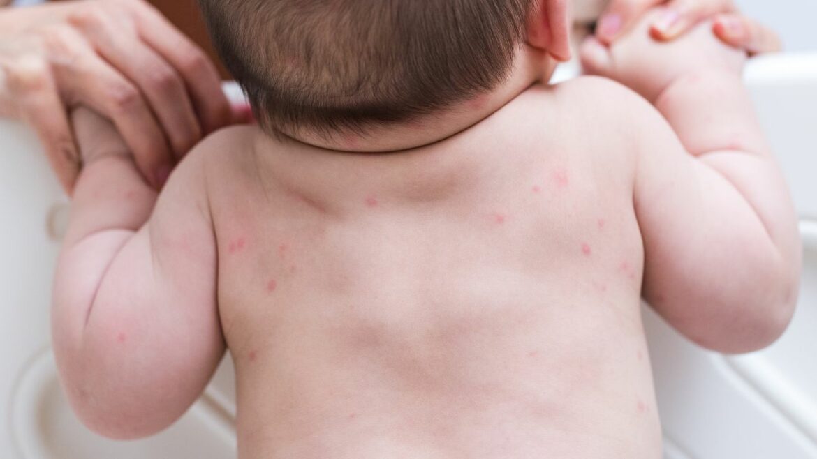Bebê deitado de bruços com alergia nas costas.