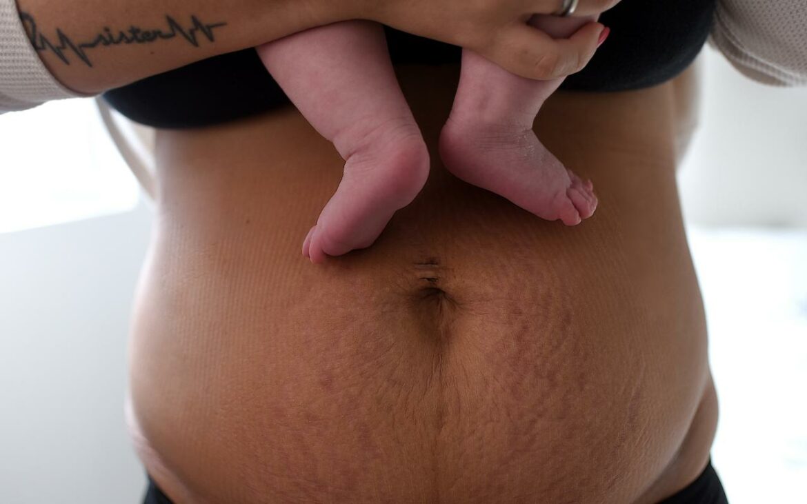 Corpo da mulher após parto normal.